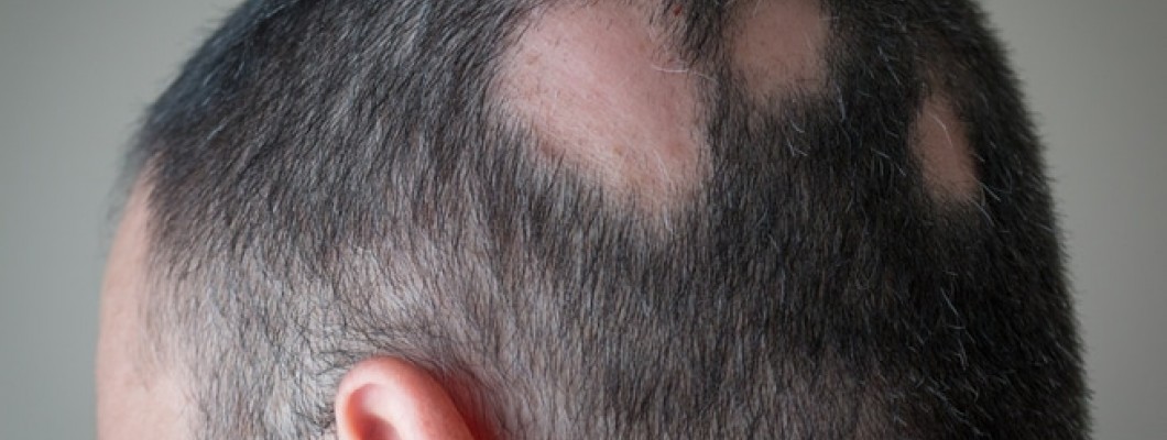 علاج الثعلبة نهائيا في الشعر والذقن والحواجب